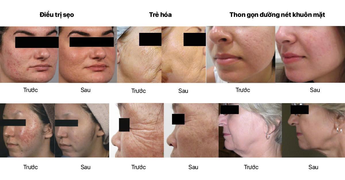 Hình ảnh trước và sau khi điều trị với EndyMed Pro