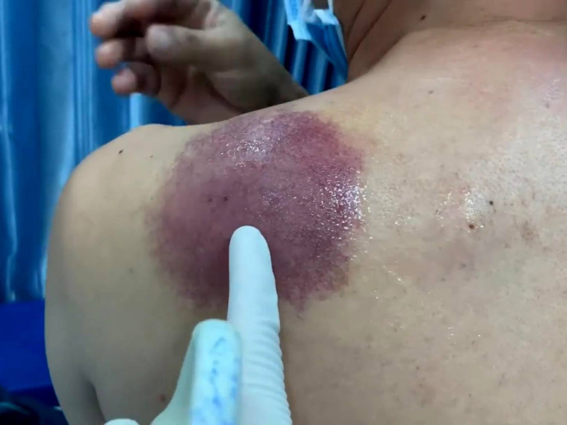 Bác sĩ Lê Lý Trọng Hưng phát hiện ung thư dạ dày từ tổn thương trên da cực hiếm