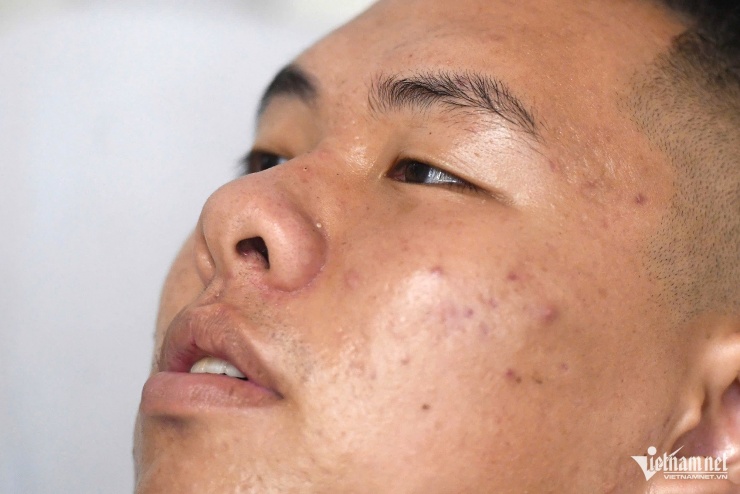 Anh Tú bị chấn thương tay sau khi thoát khỏi tàu du lịch. Ảnh: Thạch Thảo