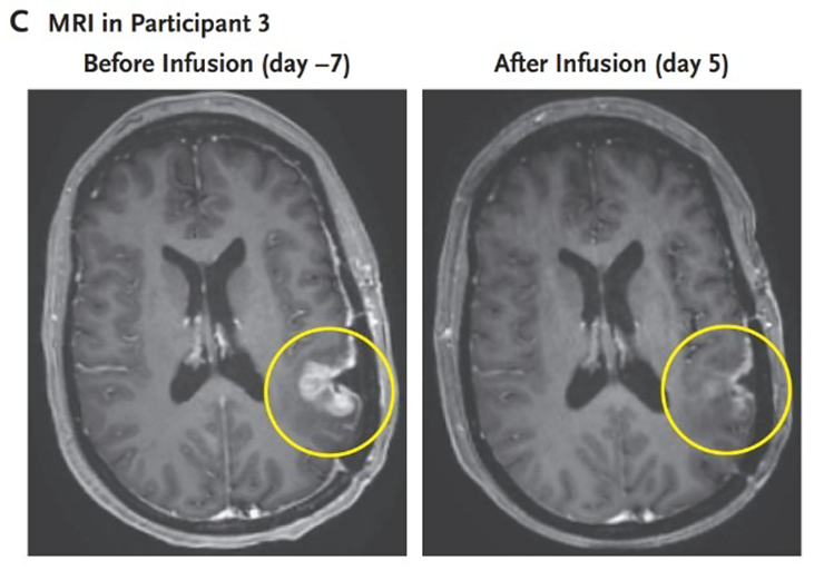 Ảnh chụp MRI cho thấy khối u đã teo nhỏ sau 5 ngày điều trị.