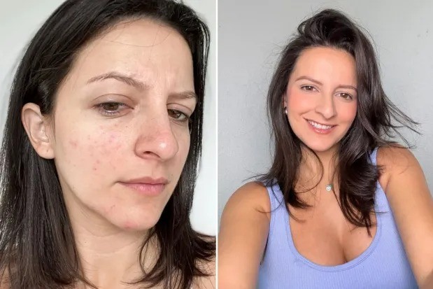 Giảm 10 kg sau một tháng, cải thiện từ tóc đến da nhờ bỏ ăn chay - 1