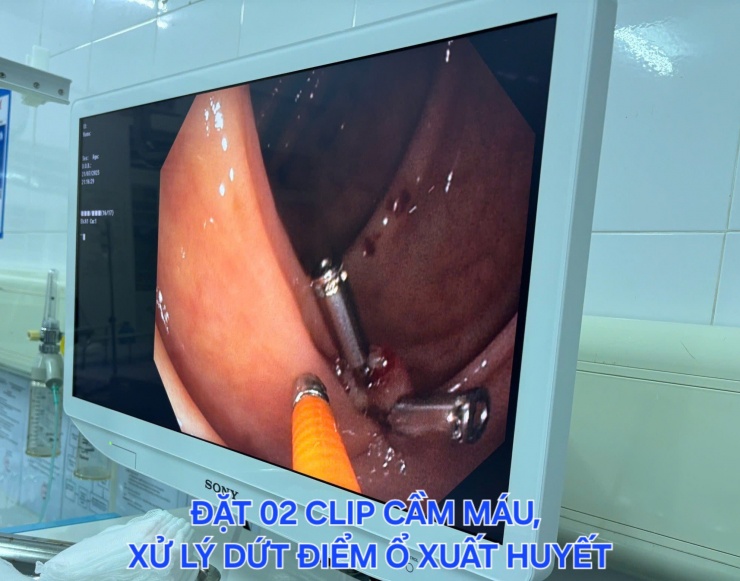 Bệnh nhân nữ 51 tuổi bị sốc mất máu cấp do chảy máu túi thừa đại tràng được các bác sĩ BV ĐKKV Cẩm Phả cứu sống trong đêm bão số 3.