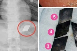 Hãi hùng một bệnh nhân  " ngáo đá "  ở TP HCM nuốt trọn bộ dao 5 món vào bụng
