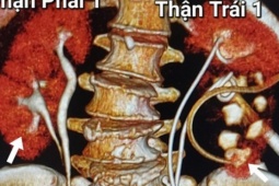 Người phụ nữ được phát hiện có 4 quả thận khi khám đau lưng