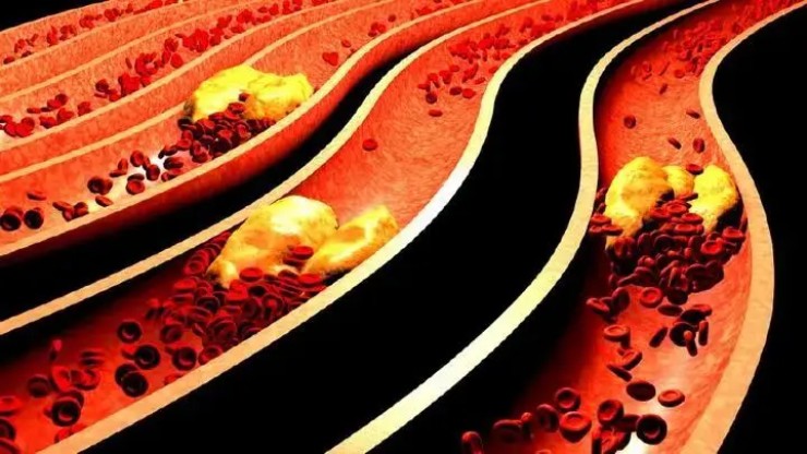 4 thói quen xấu dễ làm tắc nghẽn mạch máu, đặc biệt là điều cuối cùng - 1