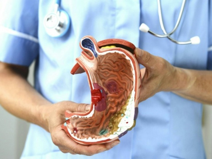 80% ca ung thư dạ dày đến từ một nguyên nhân quen thuộc