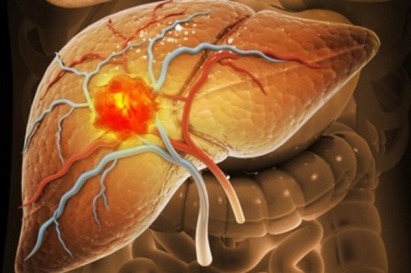 Số ca mắc loại ung thư "sát thủ" có thể tăng gấp đôi vào năm 2050