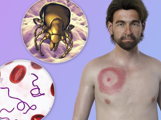 Lyme - căn bệnh khiến Justin Timberlake suy giảm sức khỏe là gì?