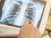 Phát hiện cùng lúc 2 loại ung thư từ triệu chứng khi ăn