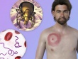 Lyme - căn bệnh khiến Justin Timberlake suy giảm sức khỏe là gì?