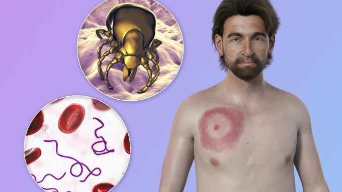 Lyme có thể gây ra các triệu chứng mệt mỏi kéo dài ngay cả sau điều trị.