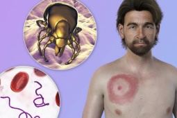 Lyme - căn bệnh khiến Justin Timberlake suy giảm sức khỏe là gì?