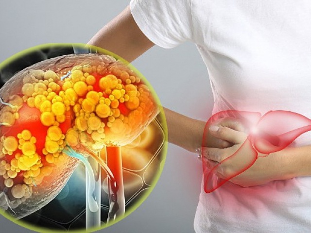 Bị gan nhiễm mỡ dù không béo phì, không uống rượu