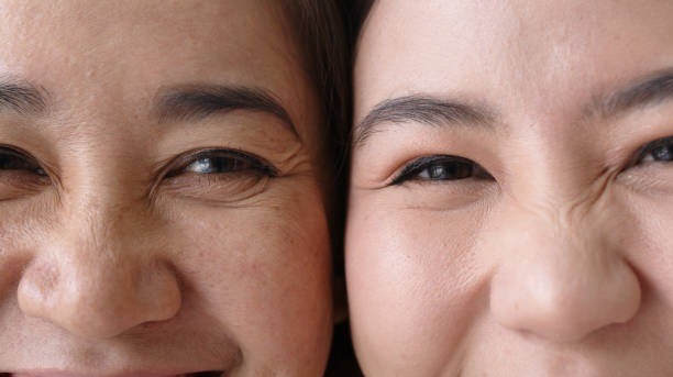 Sự hao hụt collagen theo thời gian là một trong những yếu tố khiến da kém săn chắc, hình thành nếp nhăn, vết chân chim.