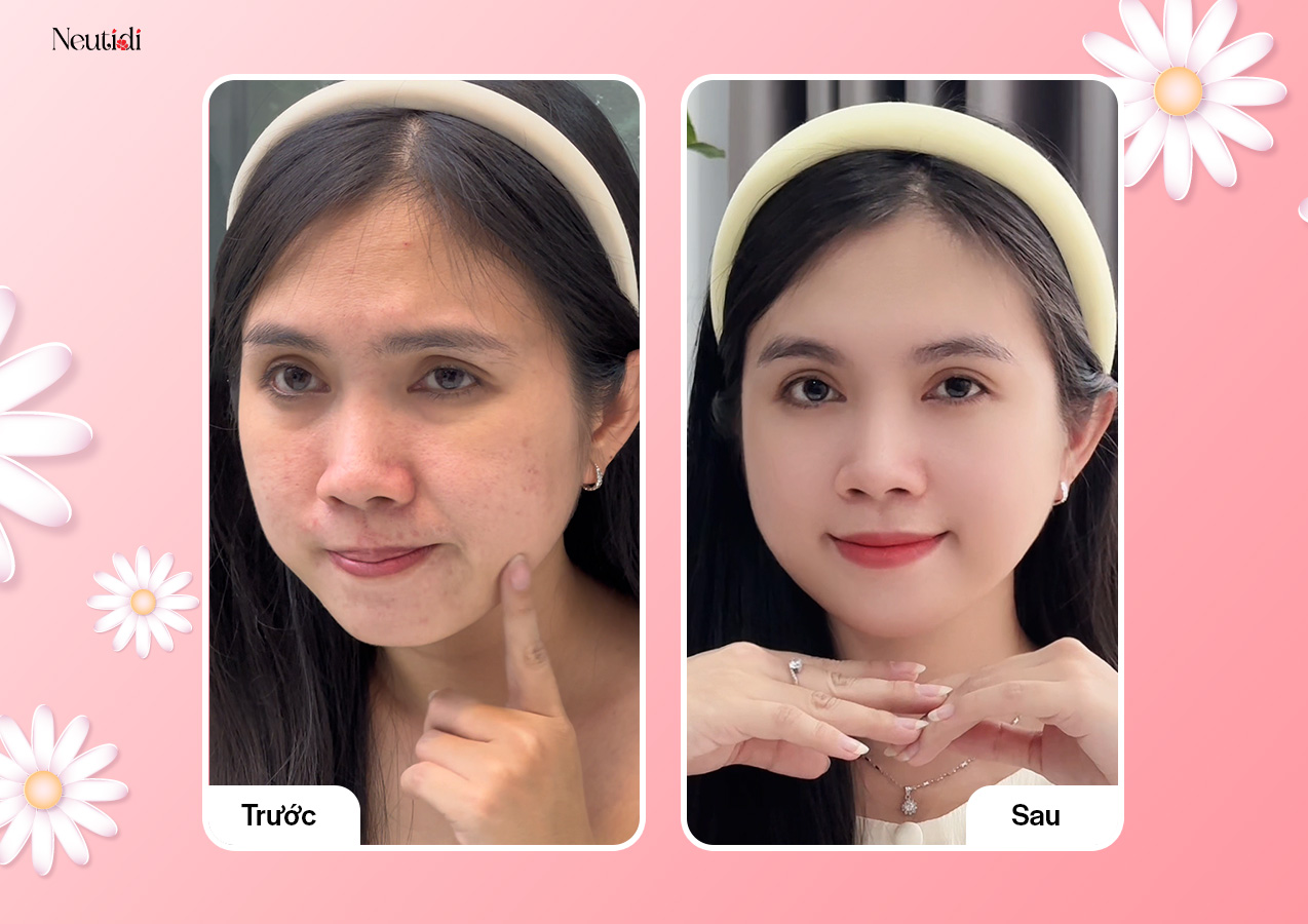 Chăm sóc da mụn kiểu mới cùng Neutidi Nhật Bản với 3 bước đơn giản mà hiệu quả - 5
