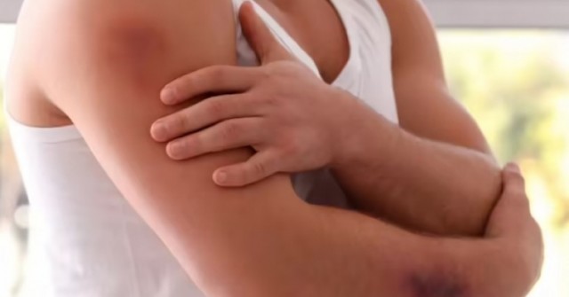 9 triệu chứng của gan nhiễm mỡ dễ thấy nhất trên da