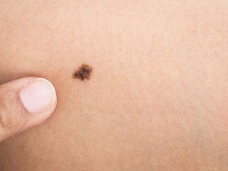 Có nốt ruồi trên mặt, người đàn ông đi khám nhiều lần mới phát hiện ung thư ác tính 