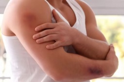 9 triệu chứng của gan nhiễm mỡ dễ thấy nhất trên da