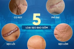 Sửa sẹo căng mô bề mặt: Giải pháp y khoa hiện đại cho làn da sẹo lồi, rỗ, sần sùi tại phòng khám PD de Paris