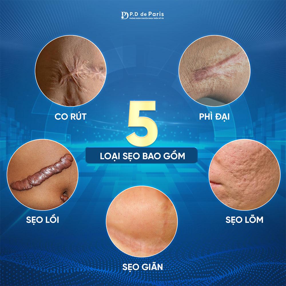 Sửa sẹo căng mô bề mặt: Giải pháp y khoa hiện đại cho làn da sẹo lồi, rỗ, sần sùi tại phòng khám PD de Paris - 1