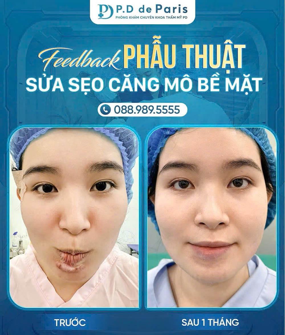 Sửa sẹo căng mô bề mặt: Giải pháp y khoa hiện đại cho làn da sẹo lồi, rỗ, sần sùi tại phòng khám PD de Paris - 3