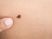 Có nốt ruồi trên mặt, người đàn ông đi khám nhiều lần mới phát hiện ung thư ác tính