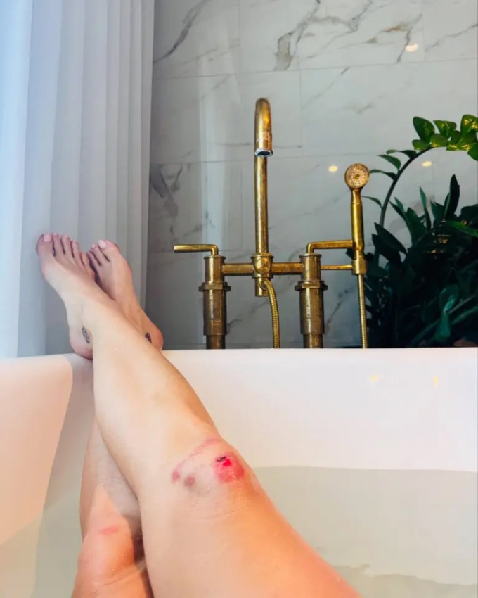 Katy Perry bị trầy xước chân.