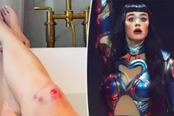 Katy Perry bị thương trong chuyến lưu diễn