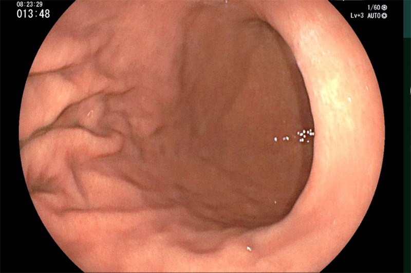 Một ca nội soi tiêu hóa tại Bernard cho thấy niêm mạc nhợt, mỏng, lộ rõ mạch máu