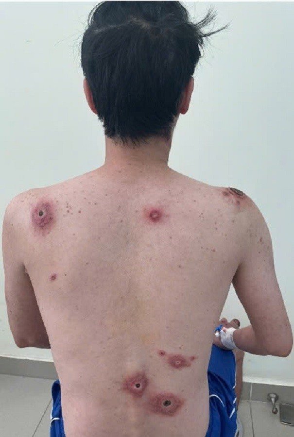 Cơ thể bệnh nhân mắc giang mai xuất hiện nhiều ổ loét, nhiễm trùng (ảnh: BVCC)