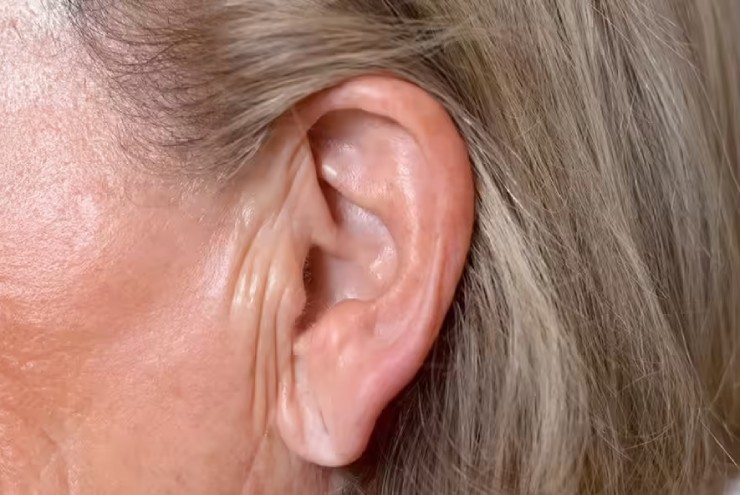 Nếp gấp ở dái tai có thể dự đoán nguy cơ đau tim, tiểu đường và đột quỵ? - 1