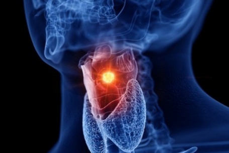 Dấu hiệu một loại ung thư có thể ẩn trong giọng nói