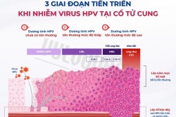 Nhiễm HPV không có nghĩa chắc chắn sẽ ung thư