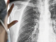 Người vợ mắc ung thư giai đoạn cuối do thói quen của chồng