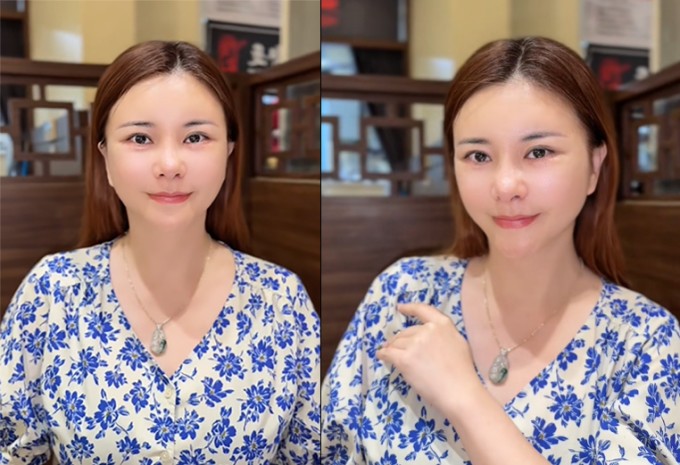 Gương mặt nữ nghệ sĩ hiện vẫn đang trong quá trình hồi phục, còn hơi sưng.