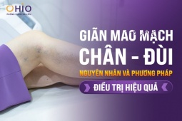 Giãn mao mạch chân đùi: Nguyên nhân và cách điều trị