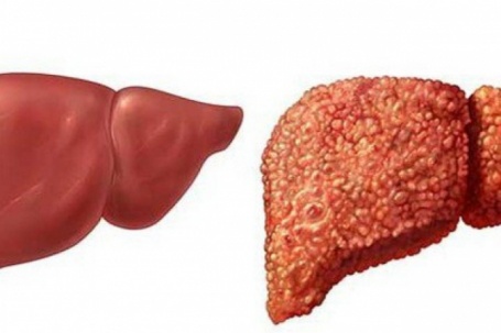 Gan 'kêu cứu' mà bạn không hay biết: 10 dấu hiệu ai cũng dễ bỏ qua