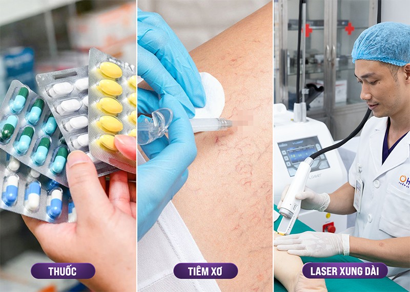 Các phương pháp điều trị giãn mao mạch phổ biến