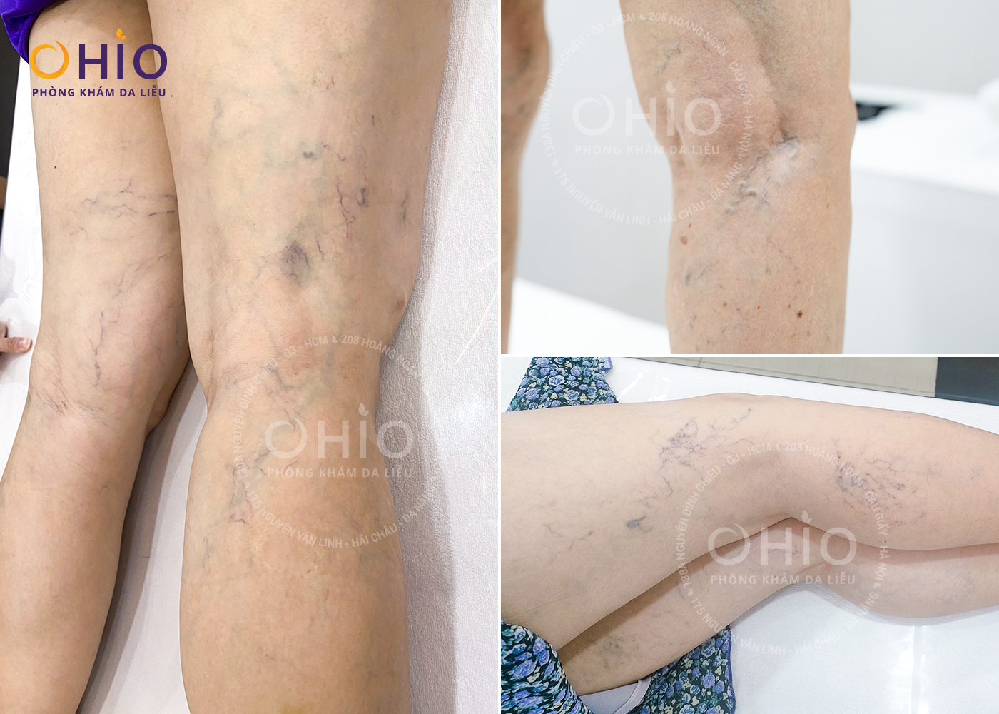 Tình trạng giãn mao mạch xuất hiện ở vùng chân, đùi