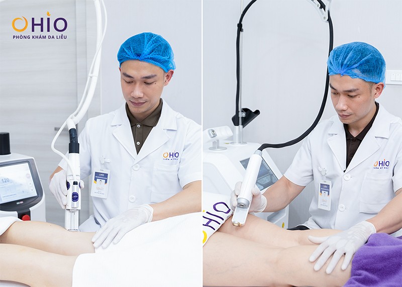 Điều trị giãn mao mạch bằng tổ hợp Laser xung dài
