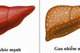 Sức khỏe đời sống - Gan nhiễm mỡ không chừa ai: 8 dấu hiệu sớm cảnh báo bạn đang đối diện nguy hiểm