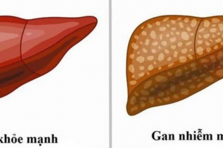 Gan nhiễm mỡ không chừa ai: 8 dấu hiệu sớm cảnh báo bạn đang đối diện...