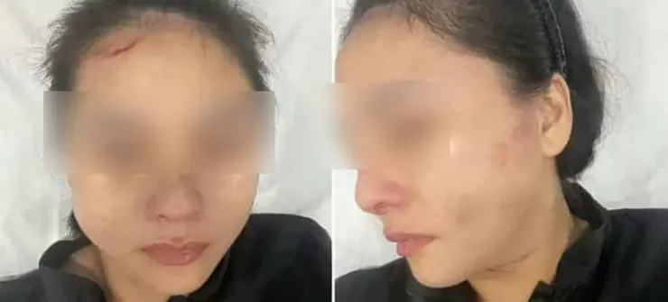Nạn nhân bị xây xát trên mặt sau khi bị người đàn ông đánh. Ảnh: Si Nguyễn