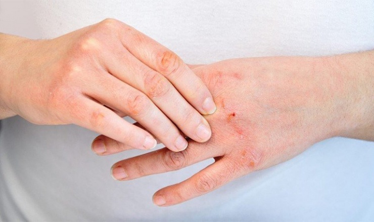 Khám bác sĩ khi có dấu hiệu bất thường trên da: Nếu có triệu chứng ngứa, mụn nước, loét da, cần khám sớm để được chẩn đoán đúng và điều trị kịp thời. Ảnh minh họa: Internet