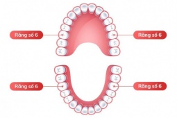 Hậu quả của mất răng số 6 sớm và cách khắc phục hiệu quả
