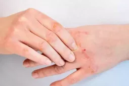 Mưa bão, lụt lội: Cẩn trọng với nguy cơ bỏng và mắc các bệnh về da