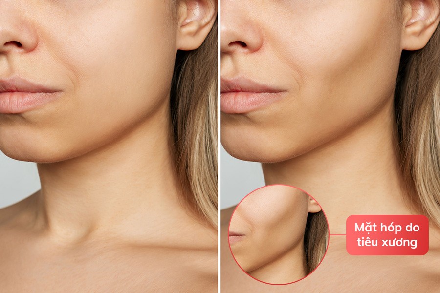 Mất răng lâu ngày gây hóp má, biến dạng khuôn mặt