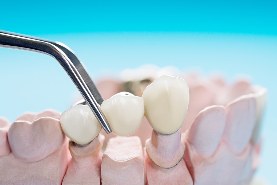 Cầu răng có tuổi thọ thấp và không ngăn ngừa tiêu xương