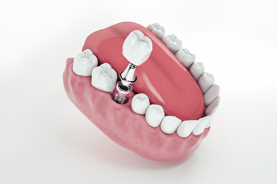 Răng Implant có thể sử dụng trọn đời và ngăn ngừa tiêu xương hàm