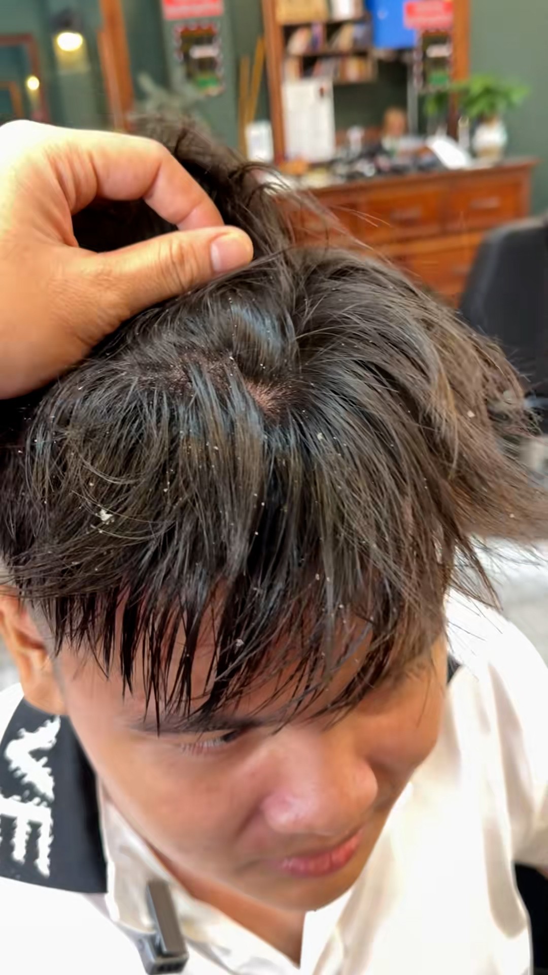 Nam sinh 2002 bị gàu ngứa tăng sinh vào mùa lạnh